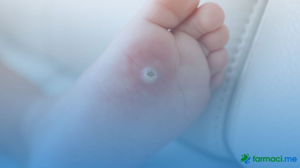 Come Capire Se Una Verruca Sta Guarendo 1 come capire se una verruca sta guarendo