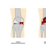come sbloccare protesi ginocchiocome si calcola larea del pentagono